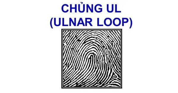 chủng vân tay sharp ulnar